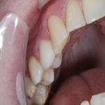 Teeth Bridge Experts in Cwm-mawr 1