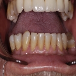 Teeth Bridge Experts in Beansburn 9