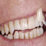 Teeth Bridge Experts in Cleddon 2