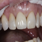 Teeth Bridge Experts in Cardew 12