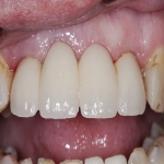 Teeth Bridge Experts in Bampton 5