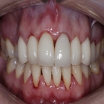 Teeth Bridge Experts in Low Torry 8