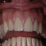 Teeth Bridge Experts in Mundesley 8