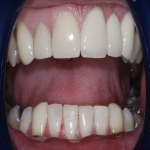 Teeth Bridge Experts in Campsall 1