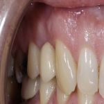 Teeth Bridge Experts in Mundesley 11