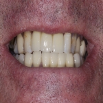 Teeth Bridge Experts in Borreraig 12