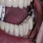 Teeth Bridge Experts in Bransgore 2